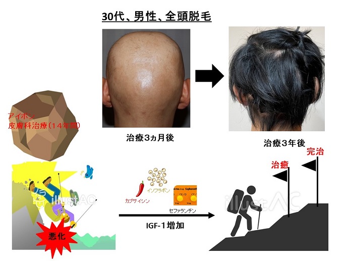 円形脱毛症　病院